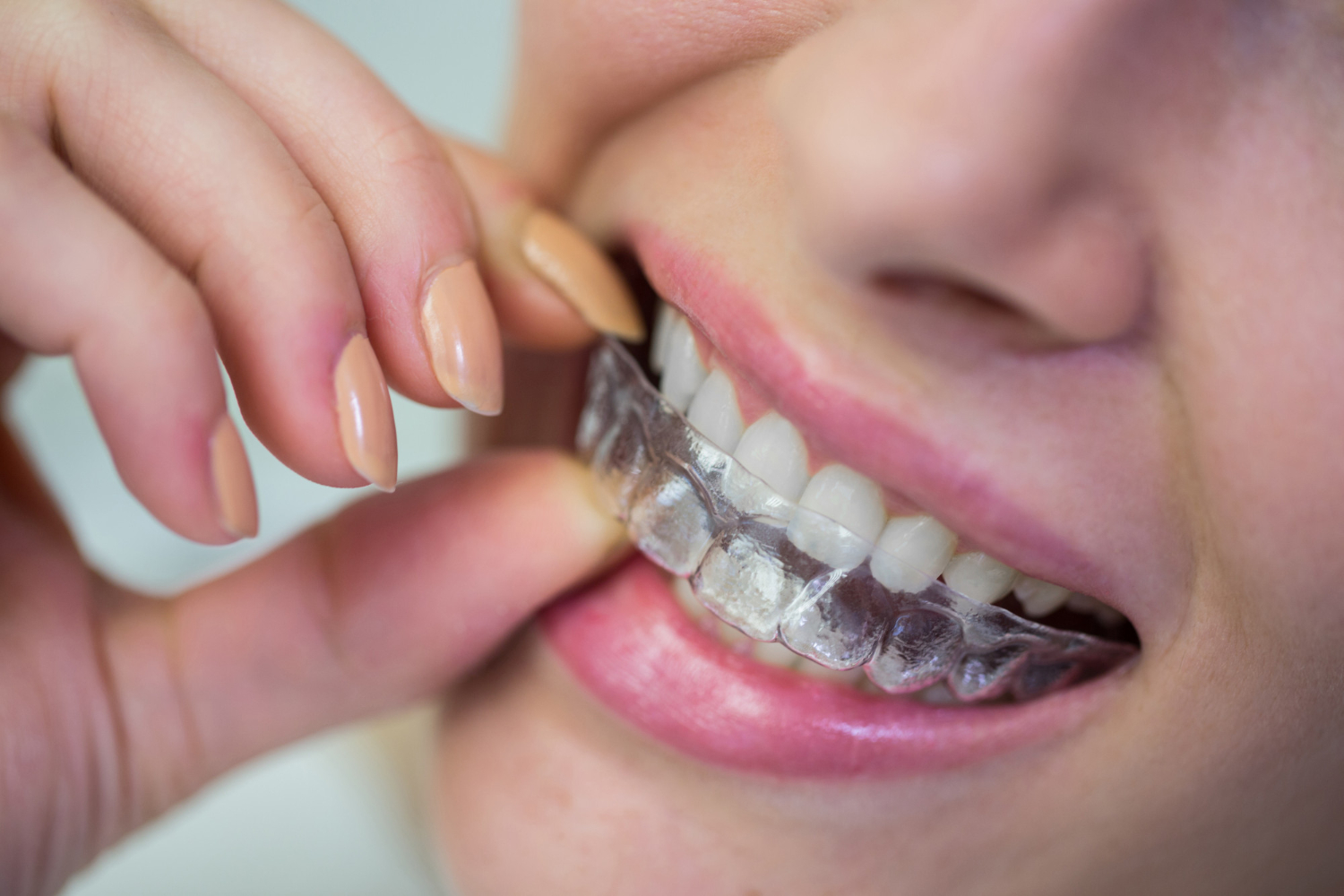 Invisalign Teen ile İçiniz Rahat Etsin