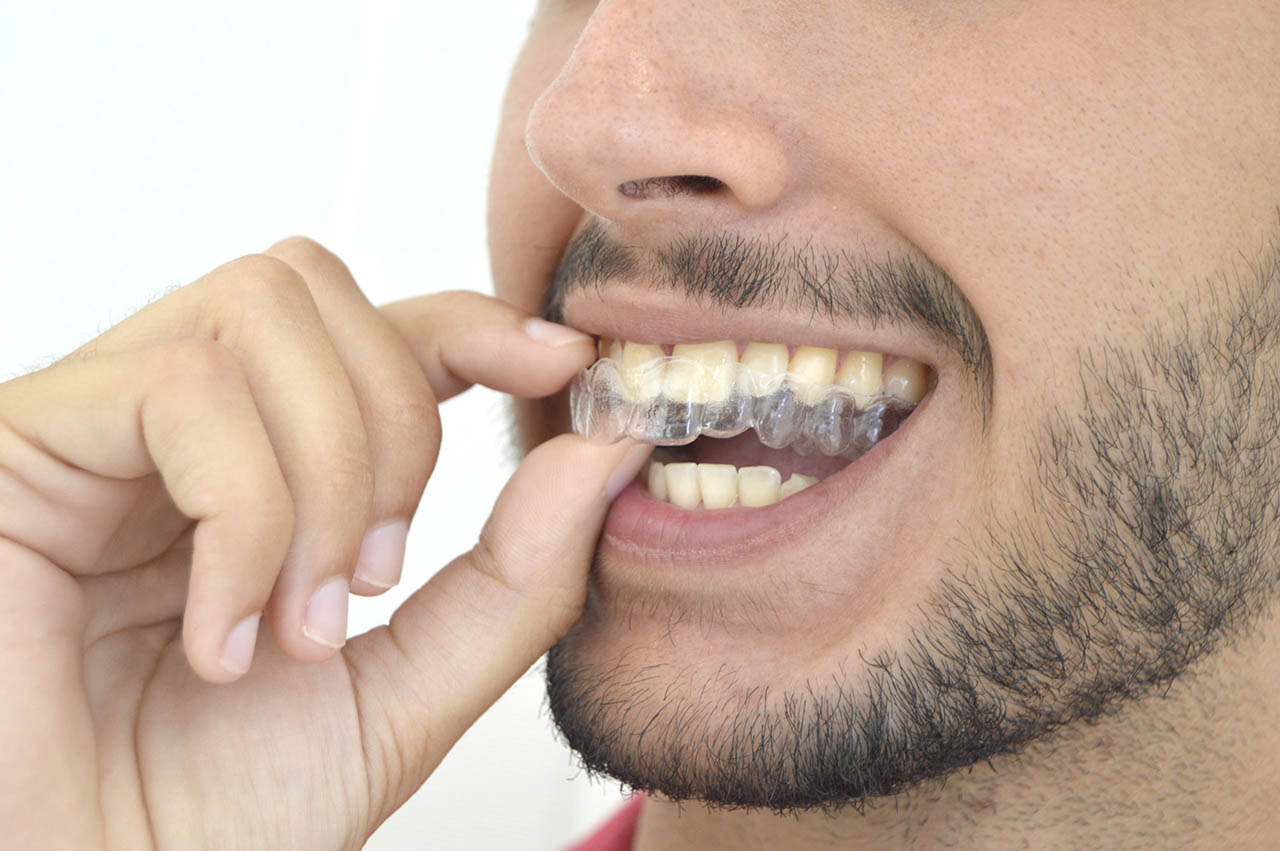 Invisalign Tedavisi Ne Kadar Etkilidir?