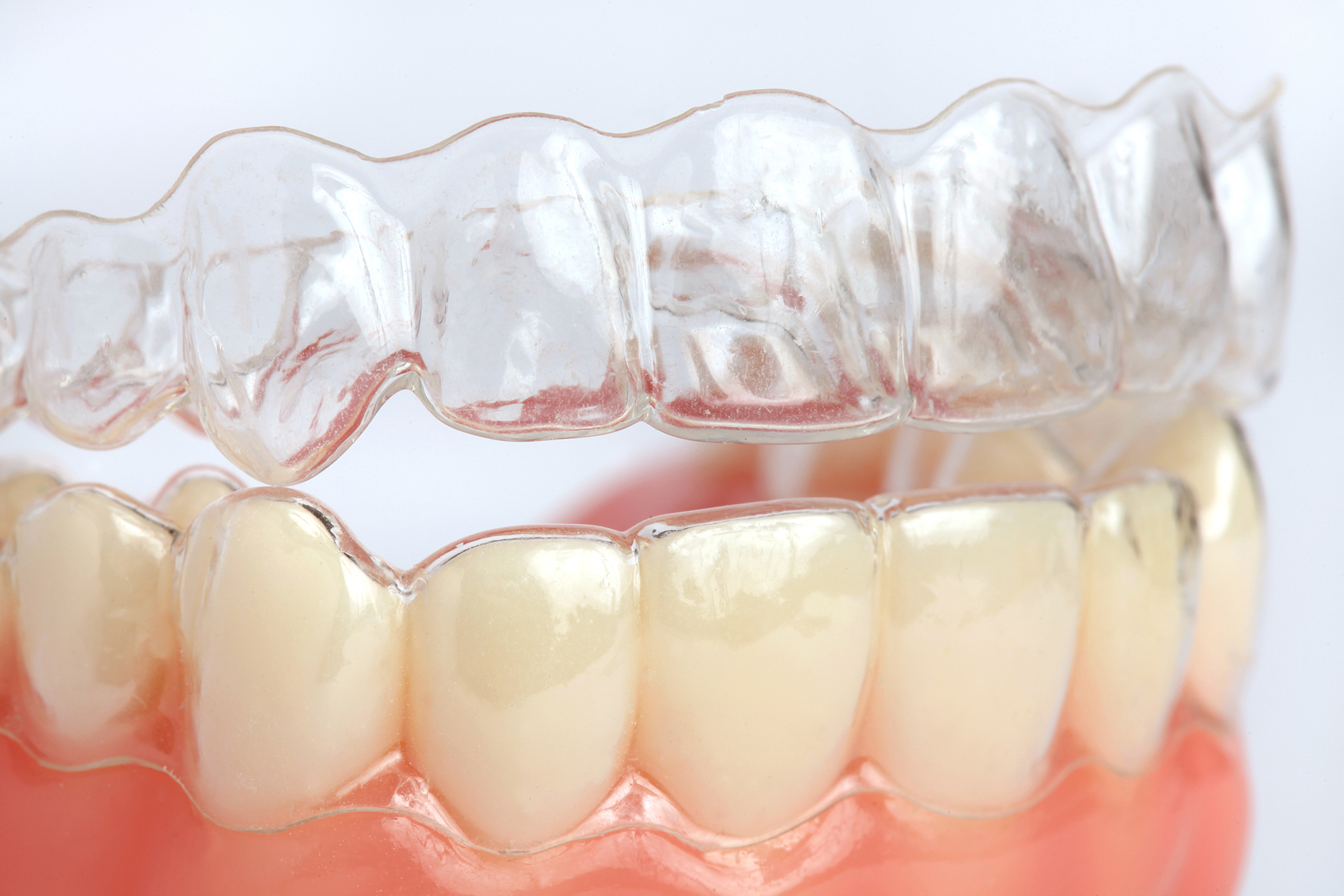 Invisalign Tedavisinde Diş Düzeltme Süresi