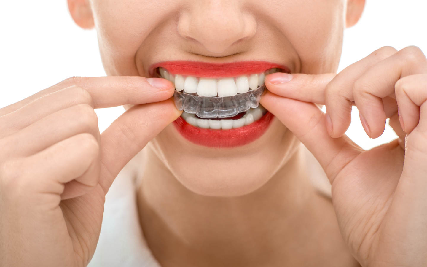 Invisalign Nedir Ne Değildir?