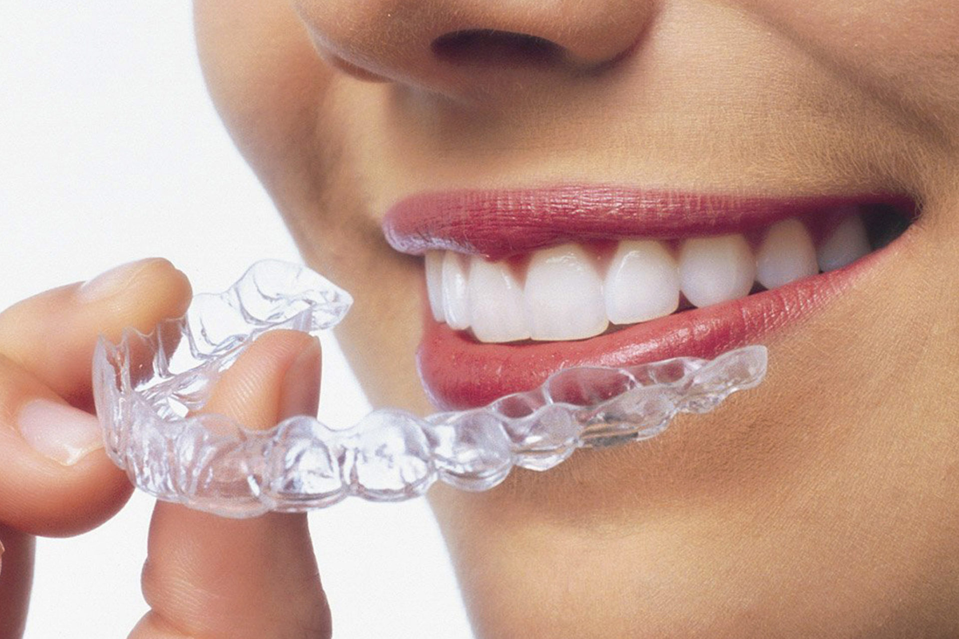 Invisalign Nedir ve Nasıl Çalışır?