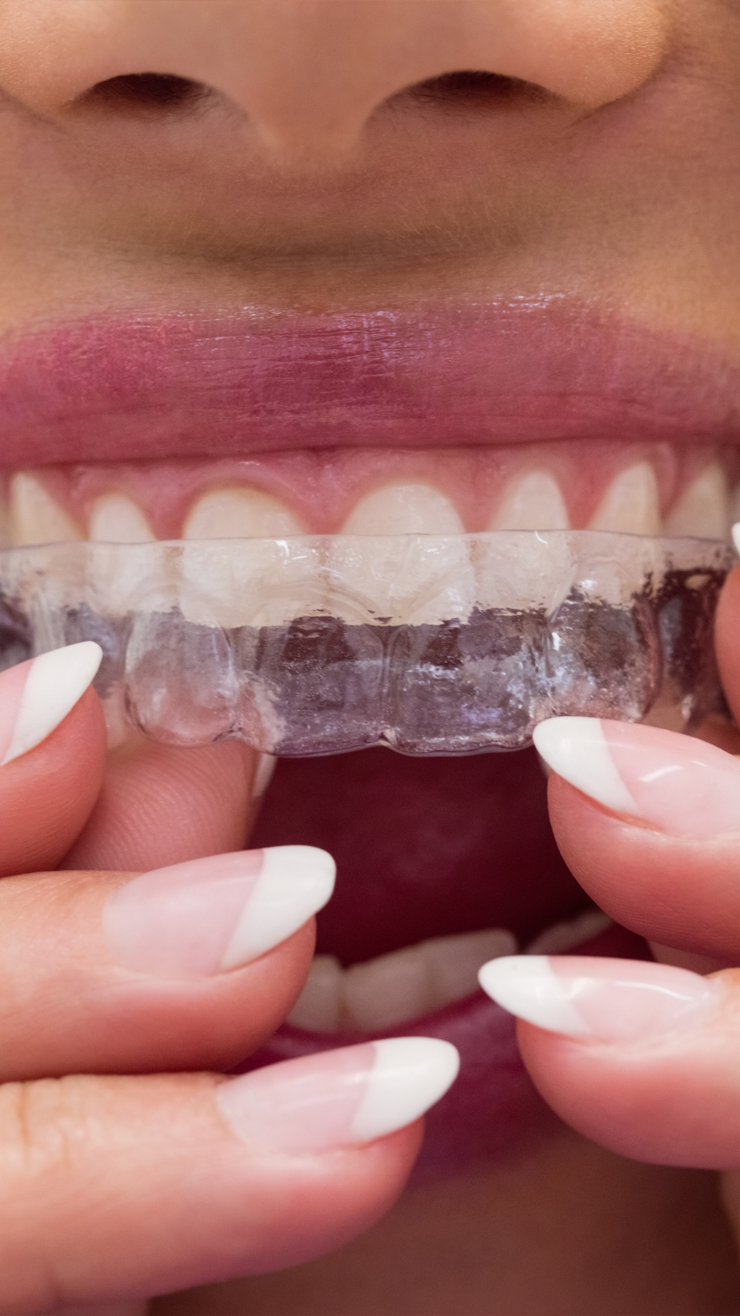 Invisalign Tedavisi